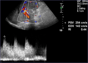 post stent HA, high vel, no PT.jpg