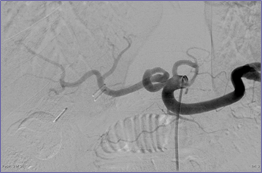 10-2-10 pre embo, splenic art steal.jpg