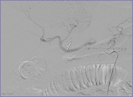 10-1-10 Angio, delayed HA opacification.jpg