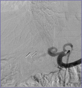 10-1-10 Angio, post HA angioplasty.jpg