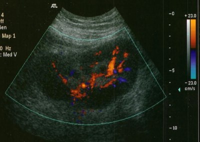 Flowers-infarct-1