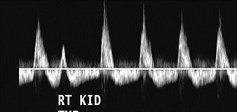 main renal artery