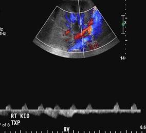 renal vein