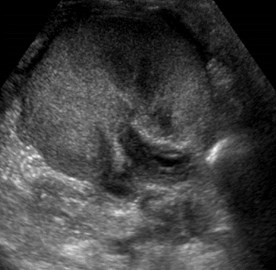 urothelial thickening