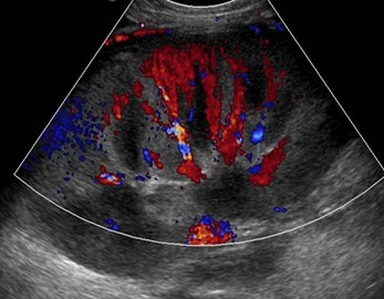 normal color Doppler