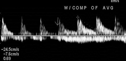 RI pre and post compression