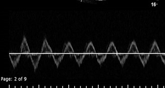 first study iliac v