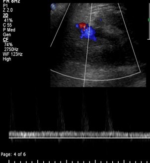 normalization of venous flow on FU