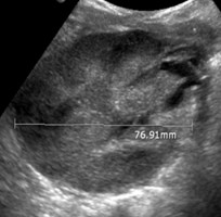 Day 1 Renal TX 2.jpg