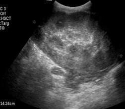 Day 2 Renal TX 1.jpg