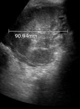 Day 2 Renal TX 2.jpg