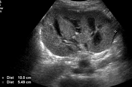 echogenic pedi kidney.jpg