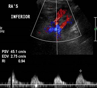 pre stent US 1