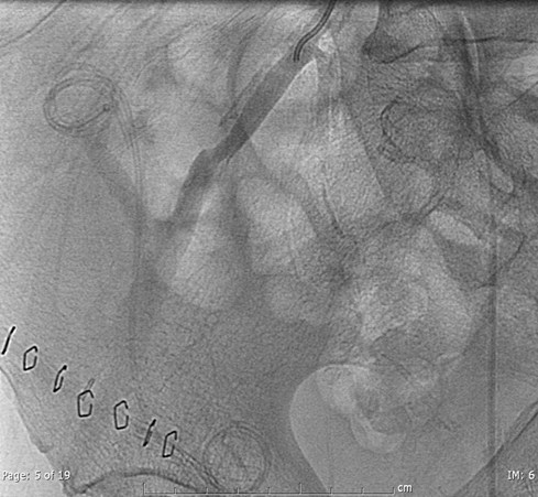 iliac angio w stenosis