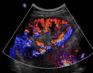 post stent renal w color