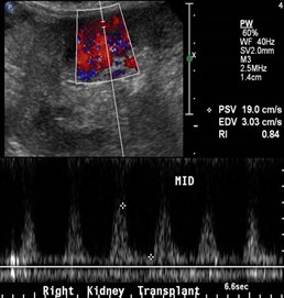 post stent Doppler 3