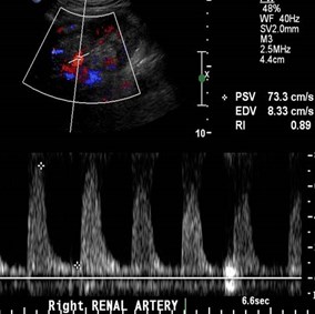 post stent Doppler