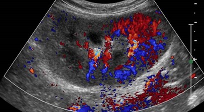 kidney with asymmetric color