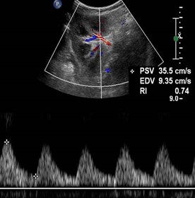 upper pole Renal A doppler