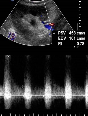 prox upper pole renal a doppler