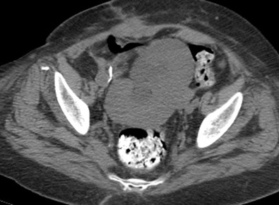 10 post torsion CT.jpg