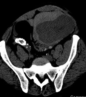 CT w bleed compressing kidney 2.jpg