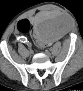 CT w bleed compressing kidney.jpg