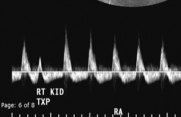 main renal artery