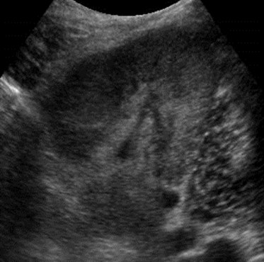 Collins, Robt, renal tx pyelo 3