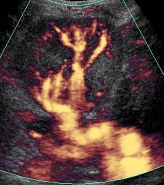 Collins, Robt, renal tx pyelo 4