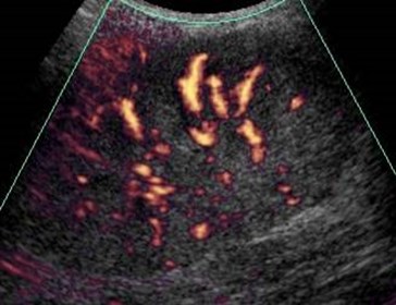 Collins, Robt, renal tx pyelo 5