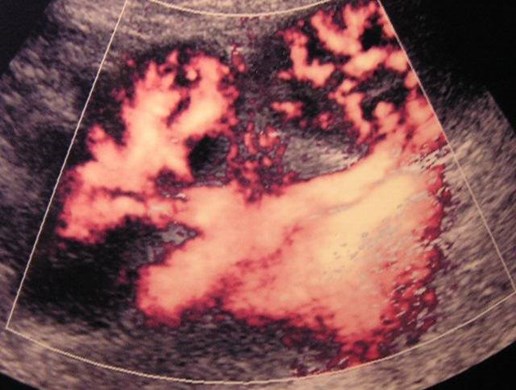 Double enbloc renal tx