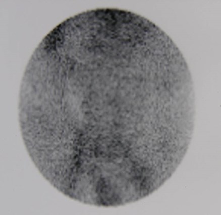 Renal scan-no flow