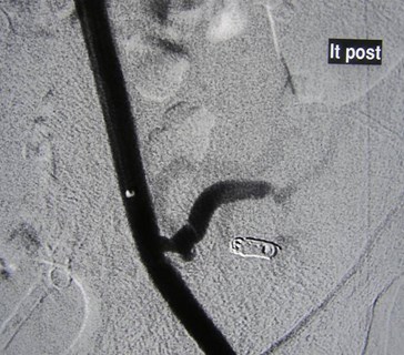 Demetrious-6 residual stenosis