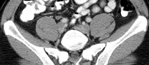 thick enhancing r ureter 3