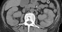 CT 3