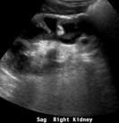 sag RT kidney