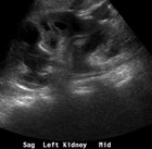 sag L kidney