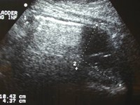 Griffin-3 emphysem cystitis