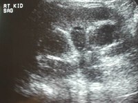Griffin-1 emphysematous pyelo