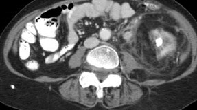 Replacement Lipomatosis of Kidney-5