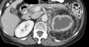 Replacement Lipomatosis of Kidney-2