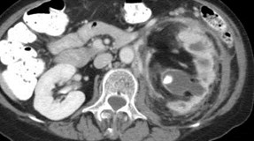 Replacement Lipomatosis of Kidney-3