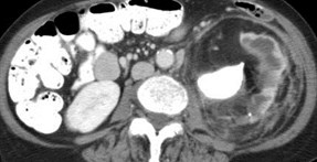 Replacement Lipomatosis of Kidney-4