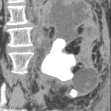 Replacement Lipomatosis of Kidney-1