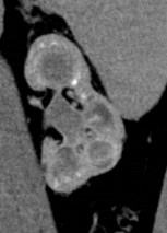 11-07 2 L Kidney