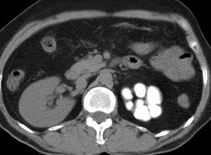 CT axial.jpg
