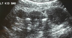 Mann-5 TB in kidney