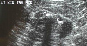 Mann-6 TB kidney