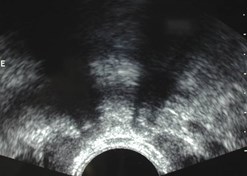 Mann-TB in vas